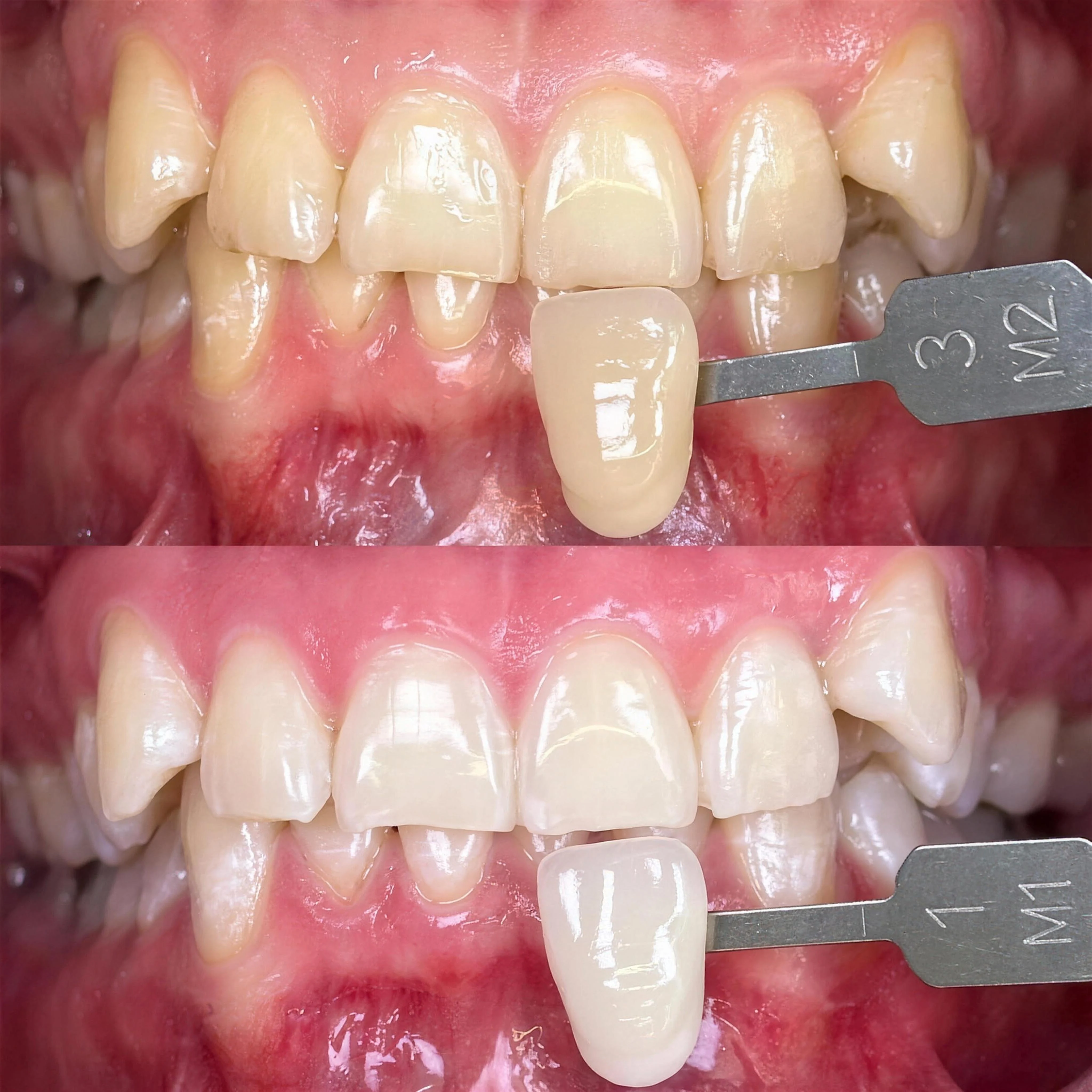 Antes del tratamiento dental